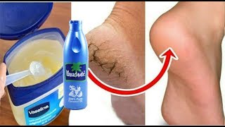 1 ही रात में फटी एड़िया से छुटकारा पाए Cracked Heels Home Remedy\ Cracked Heels Treatment [upl. by Nue]