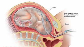 Amnioinfusionamnioinfusionsecondtrimester pregnancysecondtrimesterpregnancy [upl. by Etteluap822]