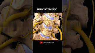 Spine model  Herniated disc  Anatomy [upl. by Wolfe]