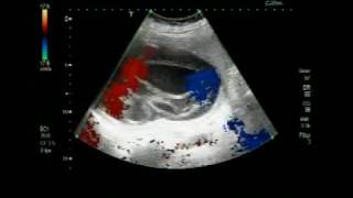 Ultrasound Video showing Hydatid Cyst in the Spleen [upl. by Pradeep]