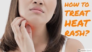 How to treat heat rashmiliaria at homeSummer special [upl. by Coucher467]