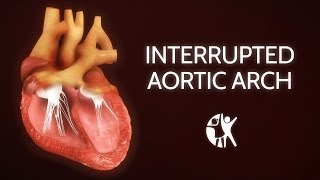 Interrupted Aortic Arch − Ventricular Septic Defect [upl. by Mackenie]