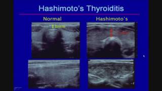 Sonographic Evaluation of Diffuse Thyroid Disease [upl. by Yhtommit728]