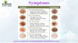 Skin Cancer Treatment in Tamil Nadu  Cancer Treatment Hospital in Madurai [upl. by Mandie]