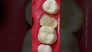 Deep cavity restoration toothcaries toothcavity [upl. by Yordan959]