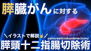 膵臓癌に対する手術 「膵頭十二指腸切除術PD」の術式と看護についてわかりやすく解説！ [upl. by Acimahs]