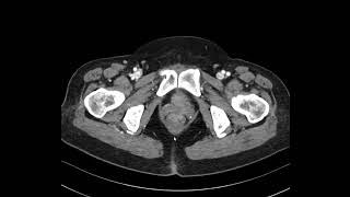 GB adenomyomatosis 2 [upl. by Sajovich]