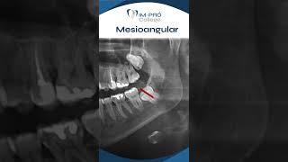 Planejando a Exodontia do Terceiro Molar Mesioangular dentista odontologia dentedosiso [upl. by Aiceled129]