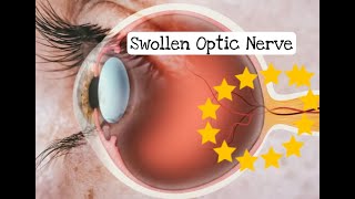 What is an INFLAMED swollen OPTIC NERVE Papilloedema papilloedema [upl. by Sosanna]