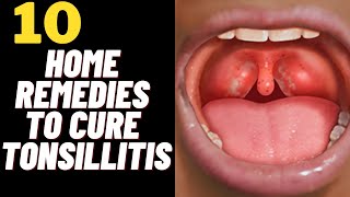 10 Home Remedies To Cure Tonsil Stones amp Tonsillitis Fast [upl. by Awahsoj]