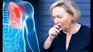 Lung cancer symptoms Persistent cough could be a sign of the condition [upl. by Nauqyaj771]