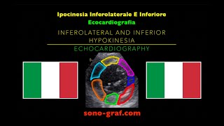 Ecocardiografia  Ipocinesia Inferolaterale E Inferiore [upl. by Ayiram]