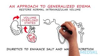 Nephrology – Generalized Edema By Timothy Yau MD and Michael Connor MD [upl. by Pesvoh]