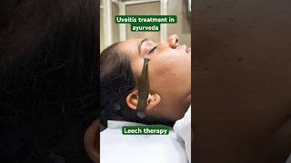 Uveitis treatment in ayurveda eyesight eyetreatment leach ayurveda [upl. by Adamson885]