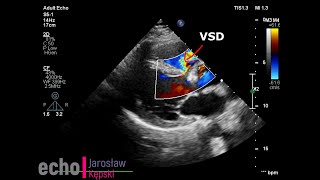 Ventricular Septal Defect VSD echocardiography echo congenital heart disease [upl. by Erme]