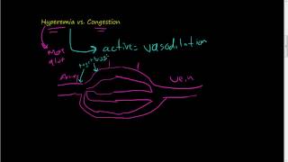 46Hyperemia vs Congestion [upl. by Aidyl]