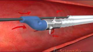 Thrombectomy Catheter  3D Medical Animation [upl. by Yslek]