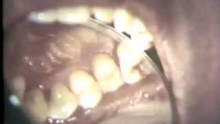 Periodontal Examination Part II Charting [upl. by Ikciv]