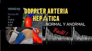 Ultrasonido Doppler de la arteria hepática  técnica espectro normal y anormal [upl. by Irrak]