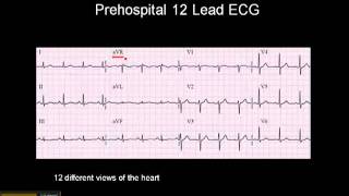 1215 Lead ECG The 12 Leads [upl. by Kcub818]