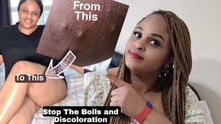 HOW TO PREVENT BOILS ON THE INNER THIGHS UNDERARM BUTTHAVE A SPOTLESS SKIN [upl. by Nethsa]