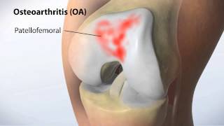 MAKOplasty Partial Knee Resurfacing [upl. by Eiramrefinnej]