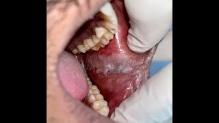 Laser surgery for Leukoplakia white lesions of mouthLasers in Precancerous conditions [upl. by Southworth79]