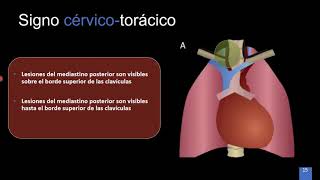 Patología del mediastino superior anterior y posterior Las 4 T [upl. by Nnek558]