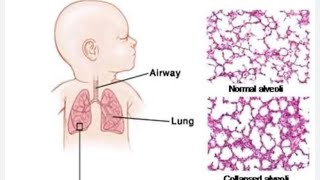 infant Respiratory Distress Syndrome RDS  Hyaline Membrane Disease [upl. by Toh]