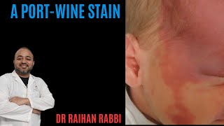 What Are PortWine Stains What Are the Signs of PortWine Stains [upl. by Ahseenal]