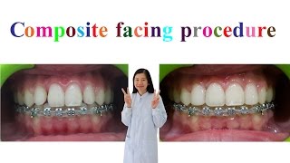 Composite facing procedure [upl. by Nyvar]