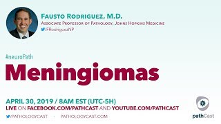 Meningiomas  Dr Rodriguez Hopkins NEUROPATH [upl. by Zeret698]