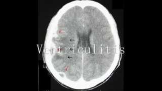 Intracranial Empyema and Ventriculitis Radiologic Features [upl. by Nilre]