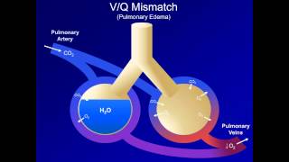 Hypoxia and Hypoxemia Mechanisms and Etiologies ABG Interpretation  Lesson 18 [upl. by Leeth]