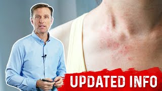 Keto Rash Is a Bile Deficiency – Bile Salts Dietary Fats and Keto Rash – Dr Berg [upl. by Fielding]