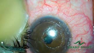 Management of LASIK FLap FoldsStriae [upl. by Tigges904]