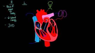 Left sided vs Right sided heart failure [upl. by Shannah76]