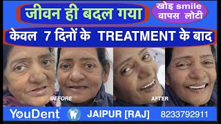 Full mouth dental implant treatment  Best dental implant centre in India Youdent hospital jaipur [upl. by Eserehs]