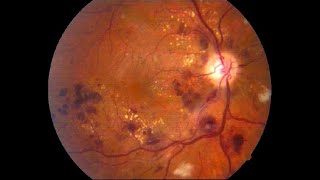 RETINOPATÍA DIABÉTICA CAUSAS SÍNTOMAS Y TRATAMIENTO TRATAMIENTO LÁSER PARA RETINOPATÍA DIABETES [upl. by Asirralc631]