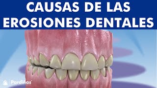 Abfracción atrición abrasión reabsorción dental y otros problemas de desgaste de los dientes © [upl. by Larred]