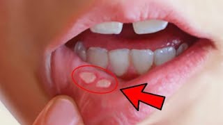 Canker sore  how to get rid of canker sores fast inside your mouth [upl. by Mcnalley845]