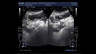 Ultrasound Video showing Intestinal obstruction with sealed perforation [upl. by Vevine]