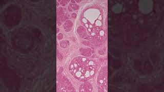 Trichoepithelioma  Pathology shorts [upl. by Anica725]