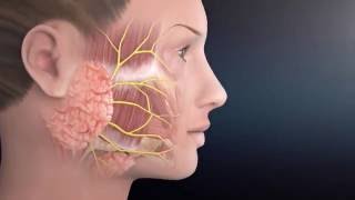 Parotid Surgery Animation  Overview of Minimally Invasive Parotidectomy [upl. by Enilasor]