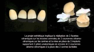 Implants  facettes et couronnes dentaires en cas dagénésie des latérales smile makeover [upl. by Ainoz]