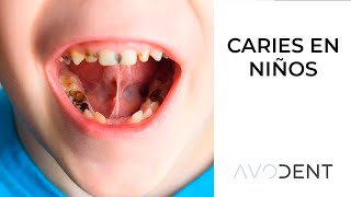 ¿Cómo evitar la caries en los niños ¿Cuál es su tratamiento  Clínica dental en Alcobendas Avodent [upl. by Penrose]