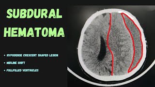 Severe Head Trauma in CT scan Before and After surgery  Subdural Hematoma [upl. by Nabal]