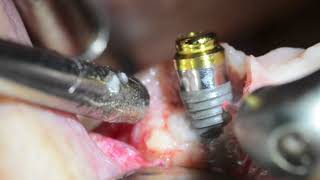 PeriImplantitis Management  Waterlase Laser Dentistry  Desai [upl. by Llerruj]