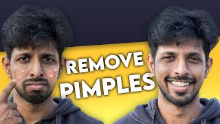 Get Rid of Pimples Forever In 2 STEPS 100 Guaranteed Results [upl. by Medor473]