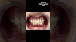 Midline diastema closer with Composite Restoration [upl. by Nnaassilem]